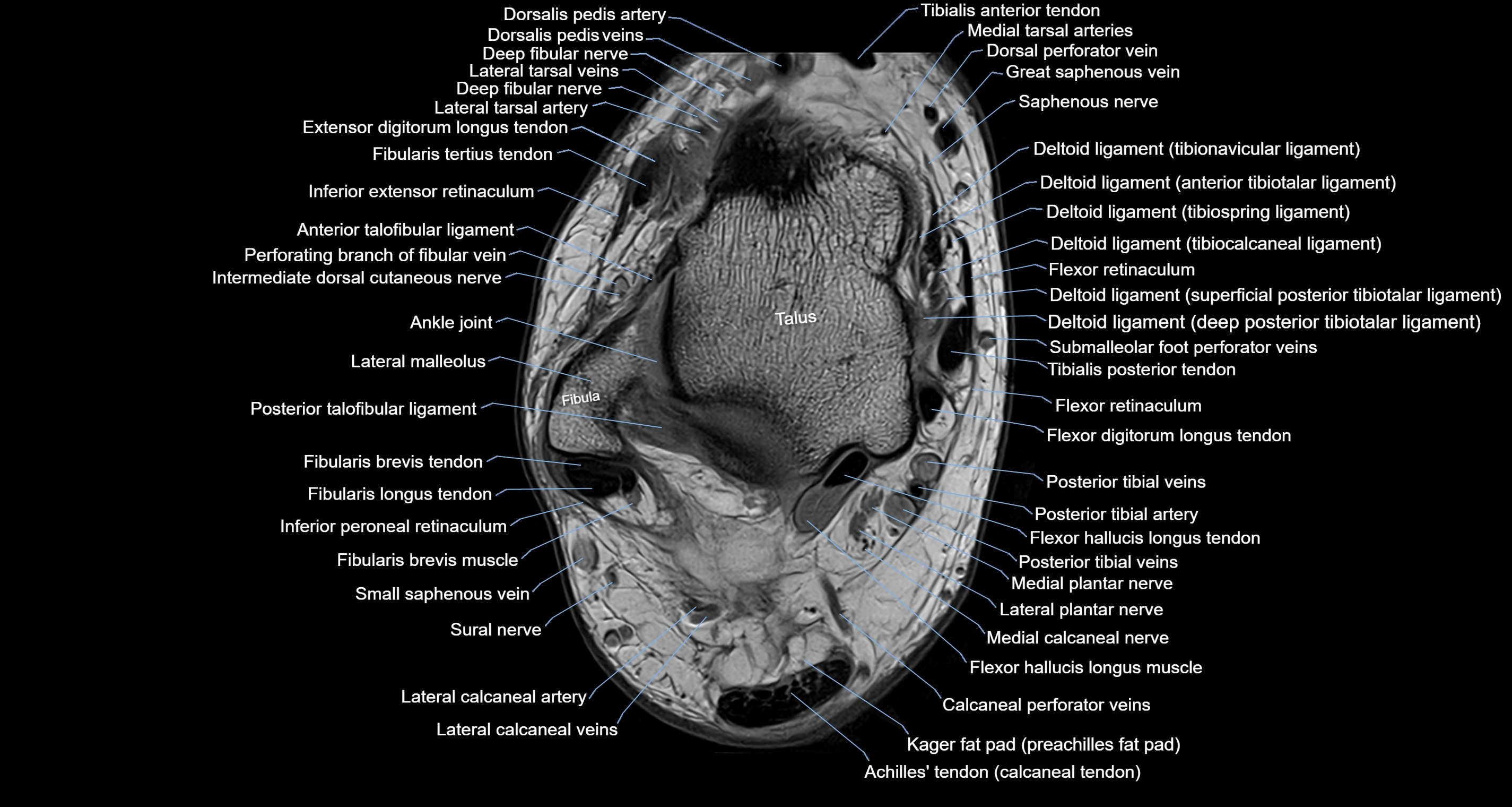 Ankle axial anatomy 3T MRI images -img-10001-00019.webp
